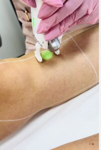 Laser hair removal treatment